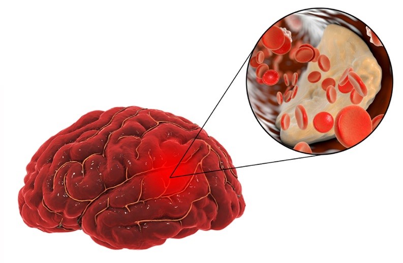 Chóng mặt khi đứng dậy