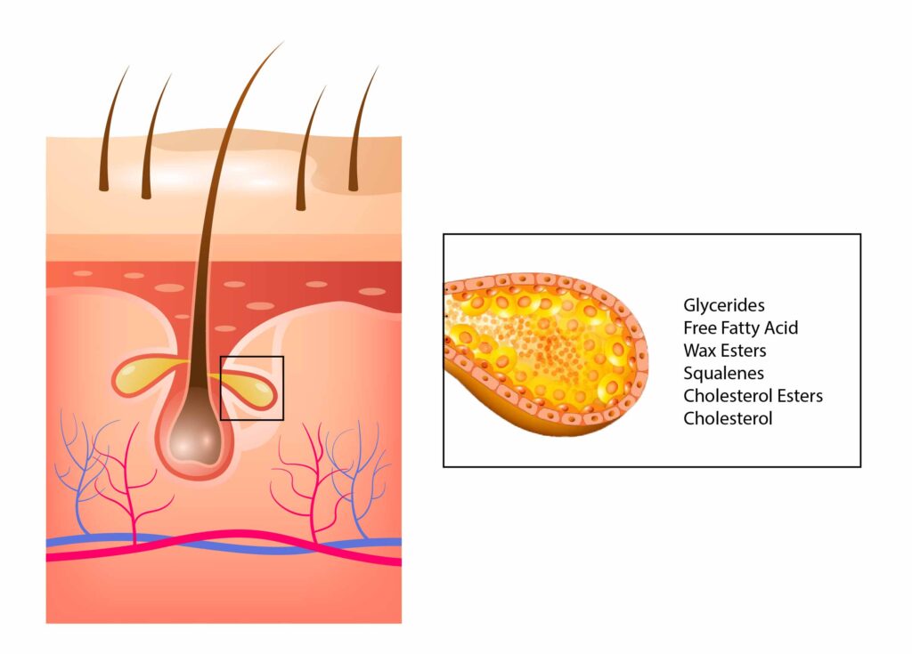 Có một số loại thức ăn gây mụn do làm tăng hoạt động của tuyến bã nhờn trên da