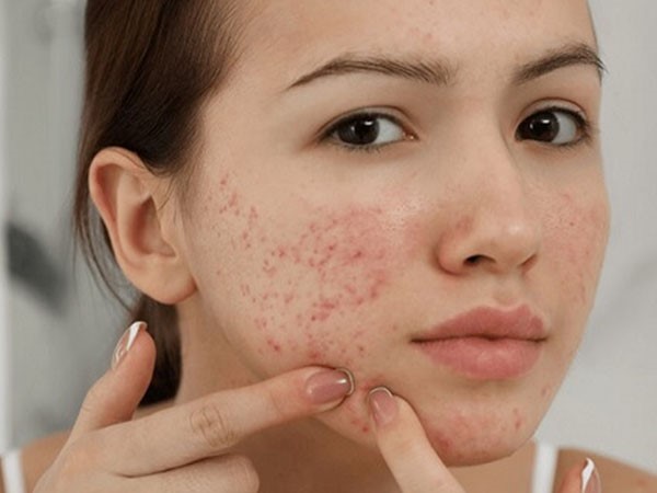 Có nhiều nghiên cứu về tác dụng của kẽm với mụn trứng cá