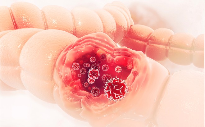 Co thắt đại tràng