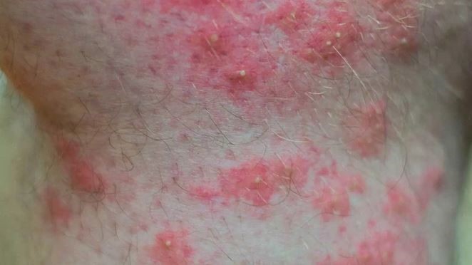 côn trùng đốt sưng to