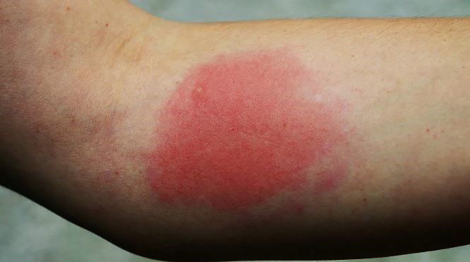 côn trùng đốt sưng to