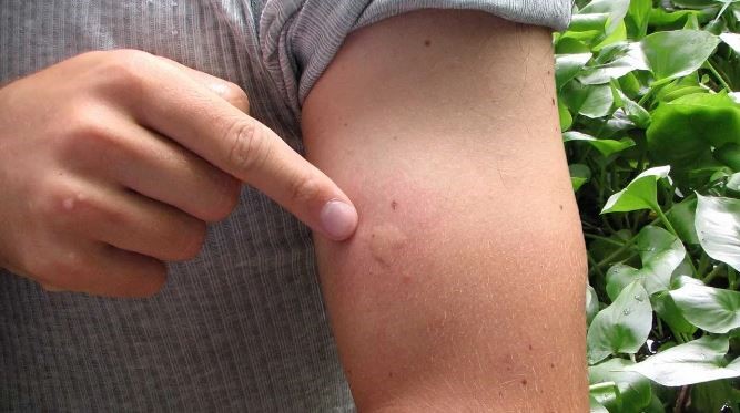 côn trùng đốt sưng to