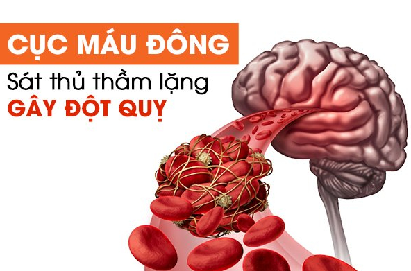 Cục máu đông là nguyên nhân phổ biến gây đột quỵ