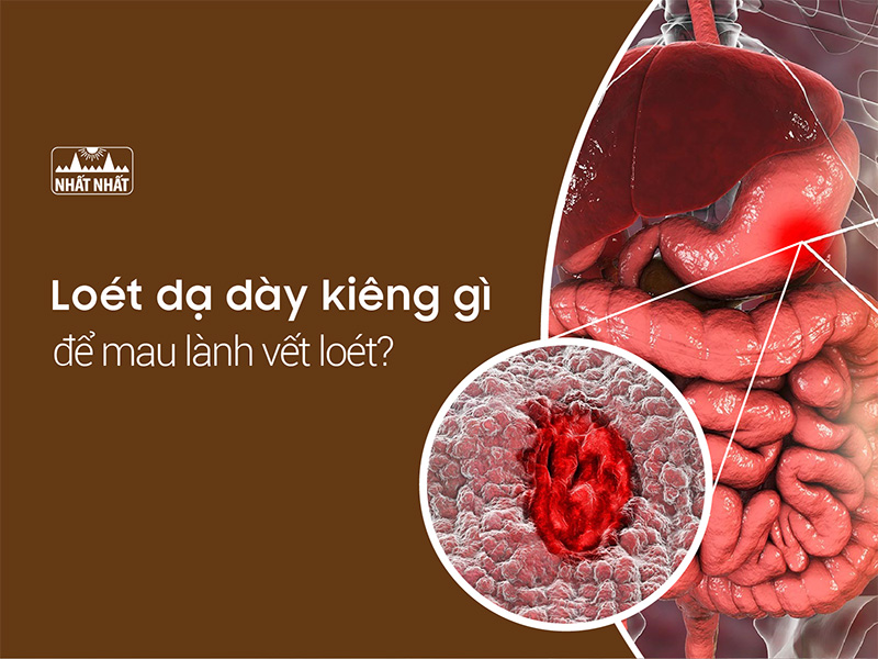loét dạ dày kiêng gì