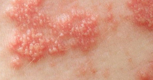 Da bị giời leo xảy ra sau nhiều năm khỏi bệnh thủy đậu