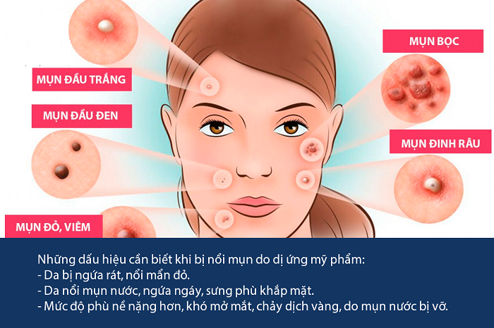 Da kích ứng mỹ phẩm 
