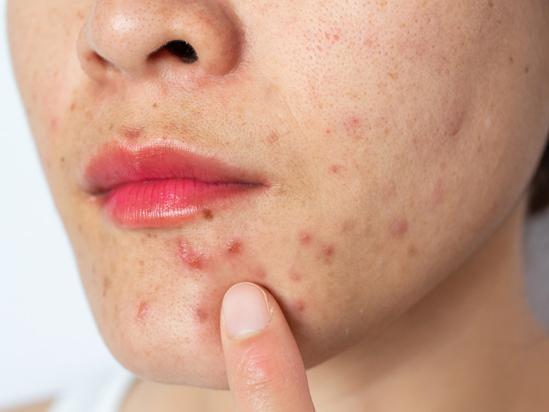 Da hỗn hợp là gì 