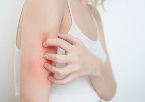 Da khô ngứa do mất độ ẩm