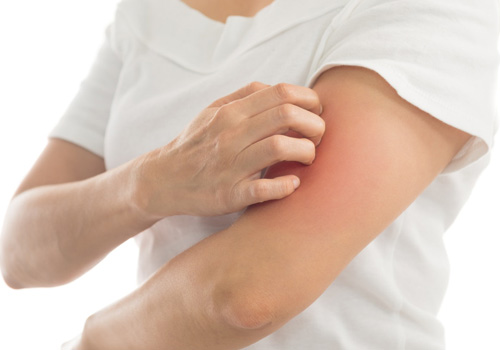 Da khô ngứa do mất độ ẩm