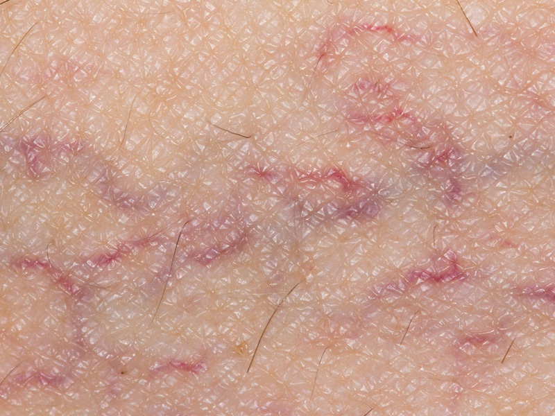 Dấu hiệu nhận biết da nhạy cảm