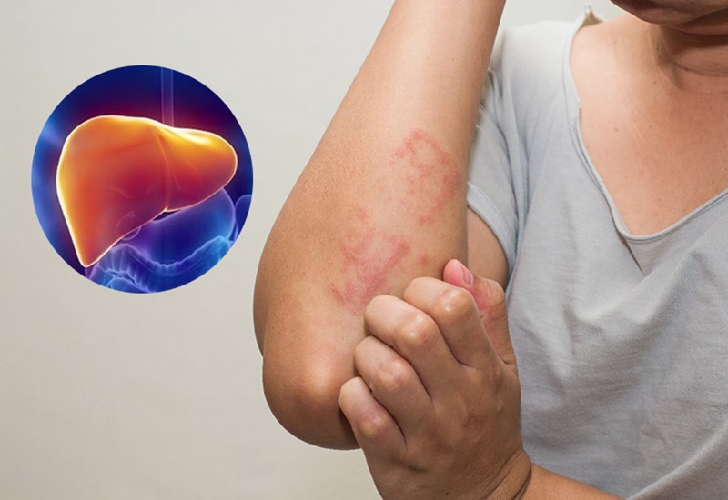 Da nổi mẩn ngứa cảnh báo bệnh gan