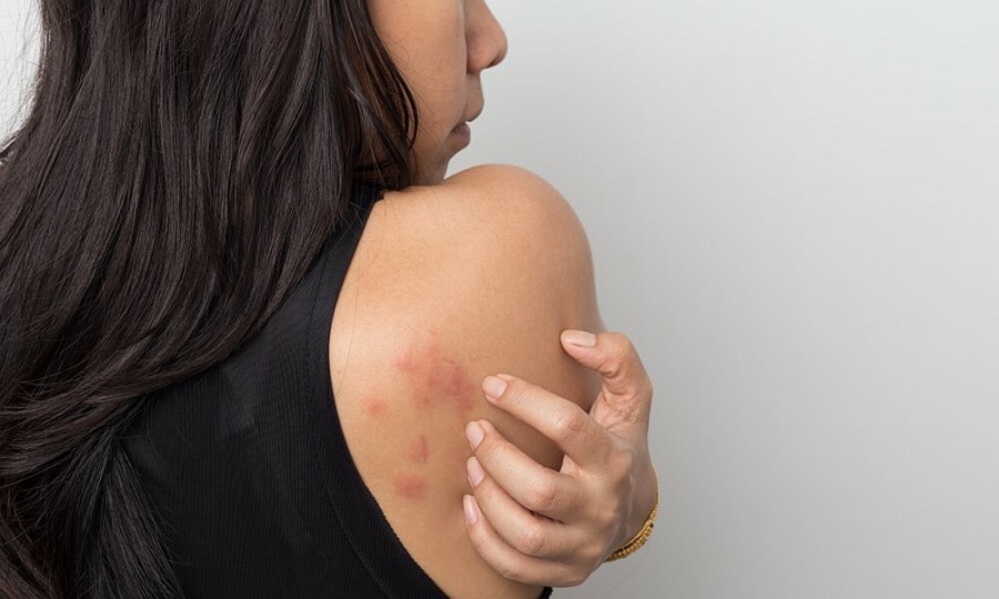 Da nổi mụn, mẩn ngứa là dấu hiệu cơ thể tích tụ chất độc