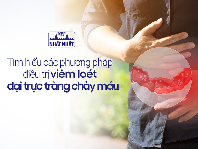 điều trị viêm loét đại trực tràng chảy máu