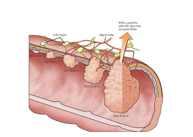 đau bụng đi ngoài