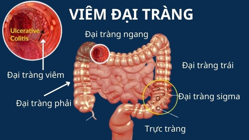 Đau bụng do viêm đại tràng thường xuất hiện ở vùng bụng dưới