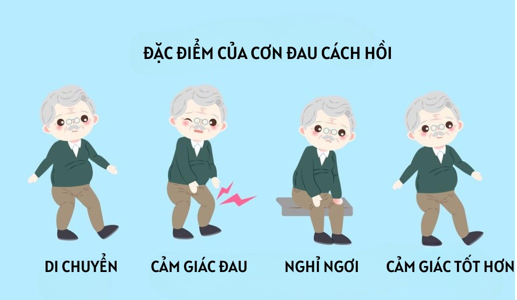 Đau cách hồi là những cơn đau xuất hiện khi đi lại và cải thiện khi nghỉ ngơi