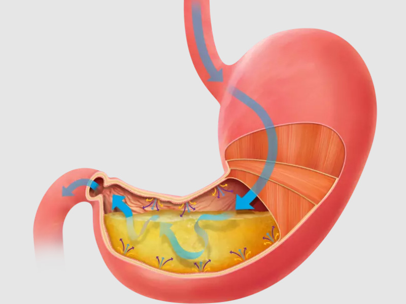 bệnh đau dạ dày