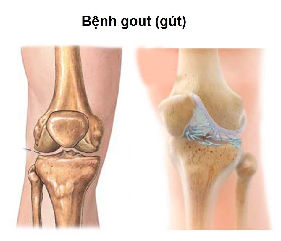 đau đầu gối phải