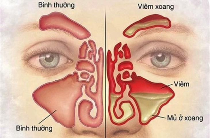 đau đầu sổ mũi đau họng