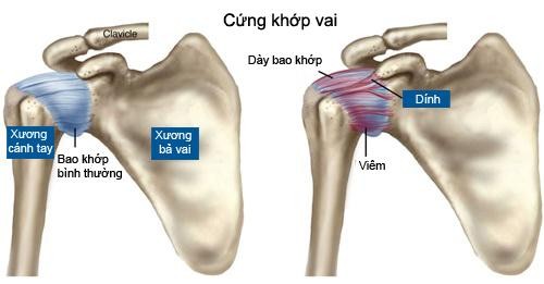 đau khớp bả vai