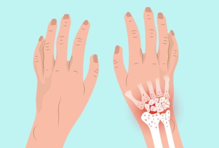 đau khớp cổ tay