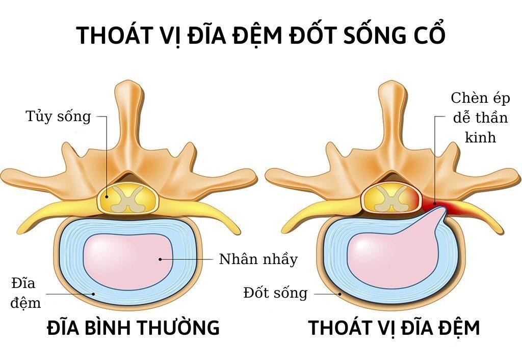 đau mỏi vai gáy là bệnh gì