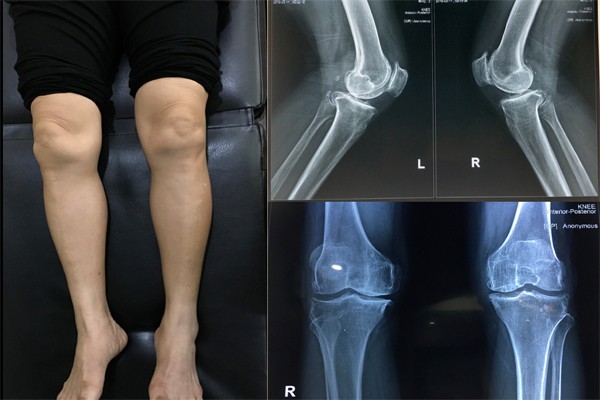 đau nhức đầu gối là bệnh gì