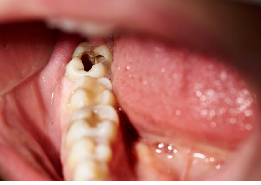 Đau nhức răng hàm trong cùng