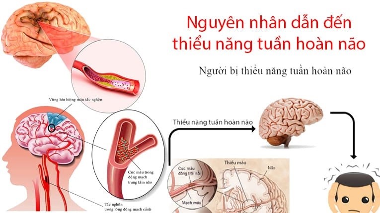 Đau nửa đầu sau