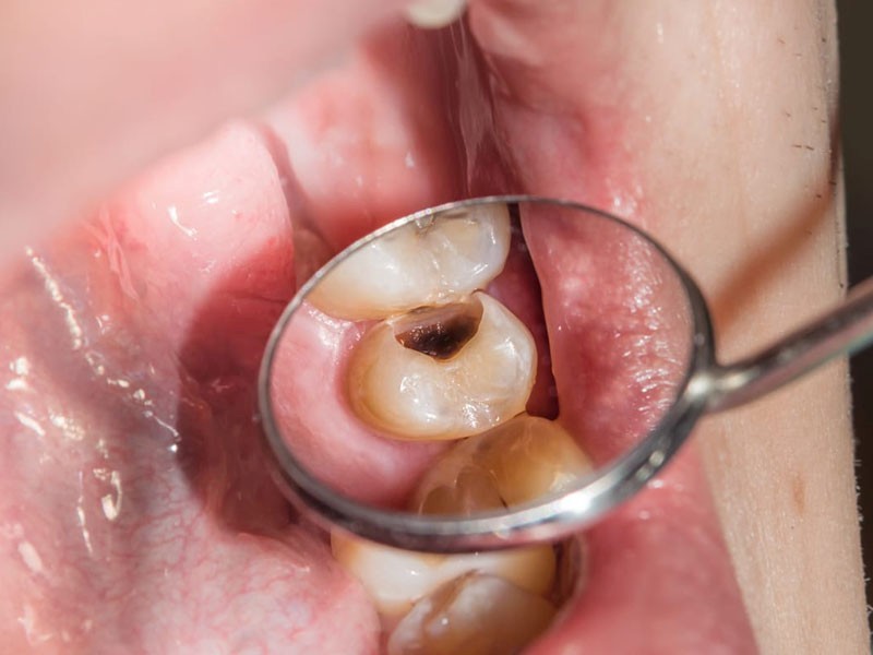 đau răng nổi hạch