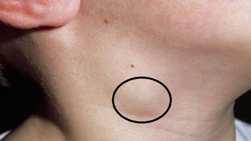 đau răng nổi hạch