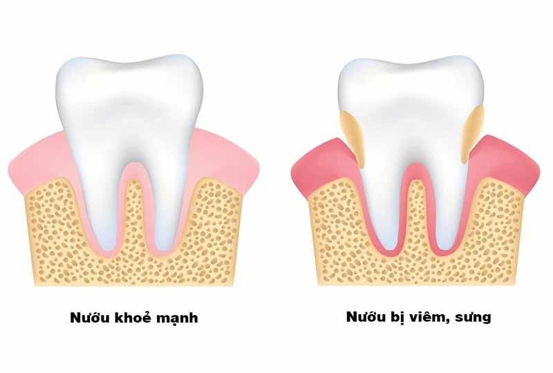 đau răng phải làm sao 