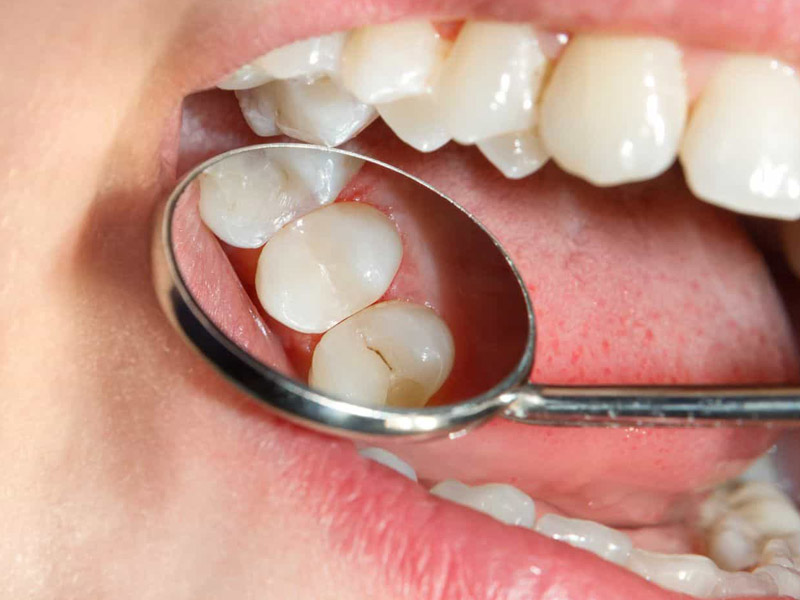 đau răng sâu nên làm gì