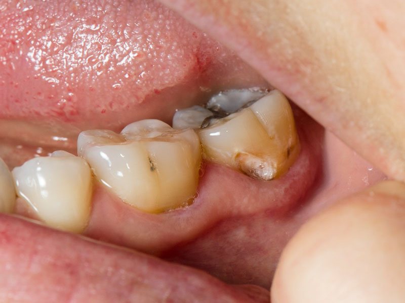 đau răng sâu nên làm gì