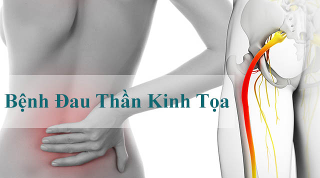 bệnh đau thần kinh tọa