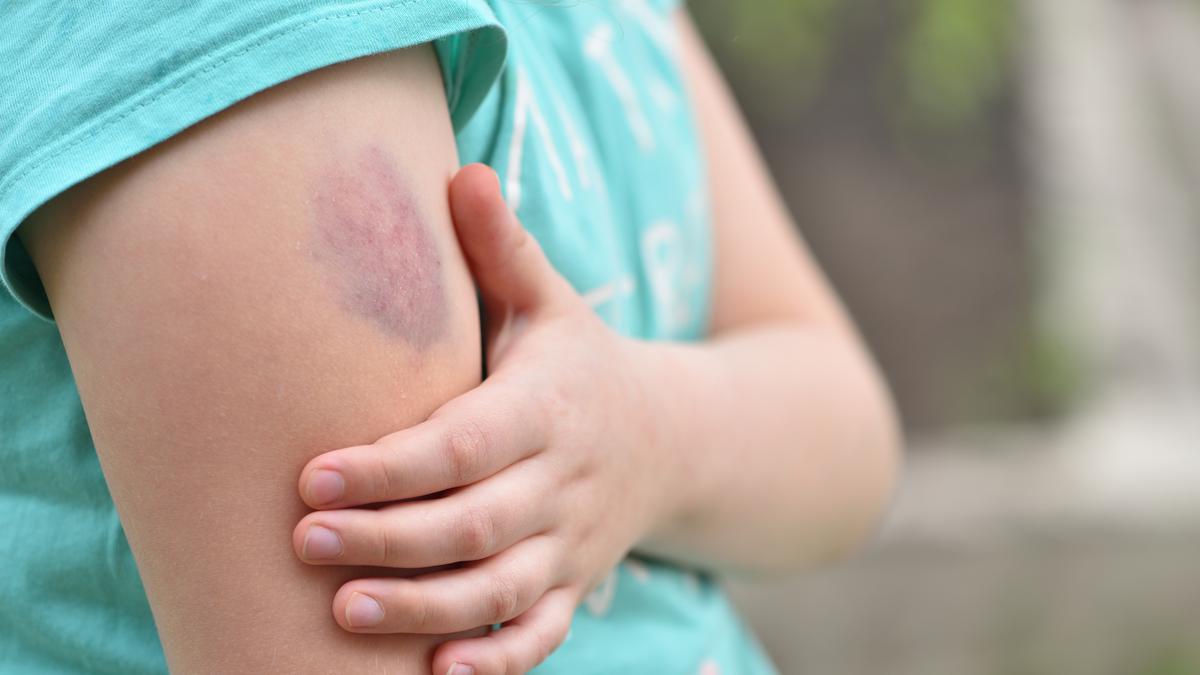 Dễ bầm tím có thể là dấu hiệu cảnh báo suy giảm chức năng gan