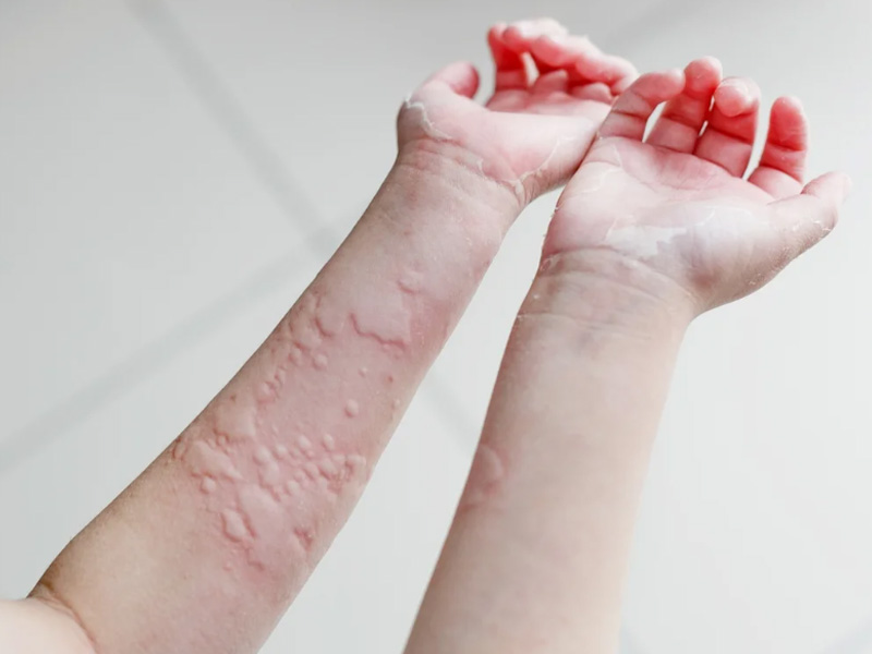 Dị ứng nổi mề đay 