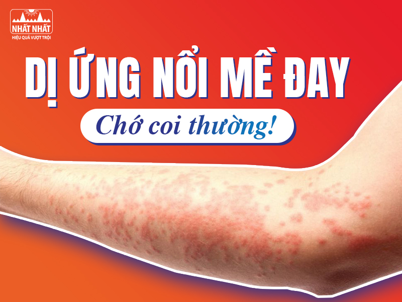 Dị ứng nổi mề đay gây ra nhiều khó chịu cho người bệnh