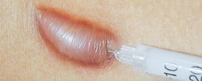 Điều trị sẹo lồi cần sự can thiệp của các chuyên gia thẩm mỹ