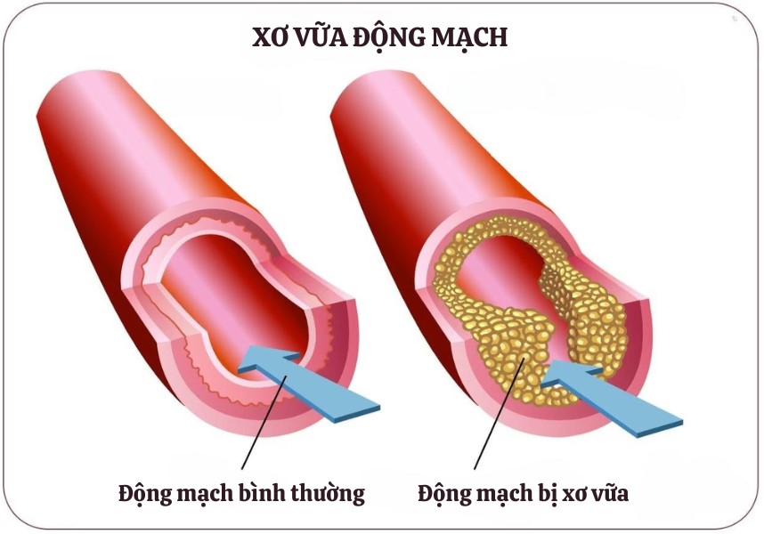 Động mạch bình thường và động mạch bị xơ vữa