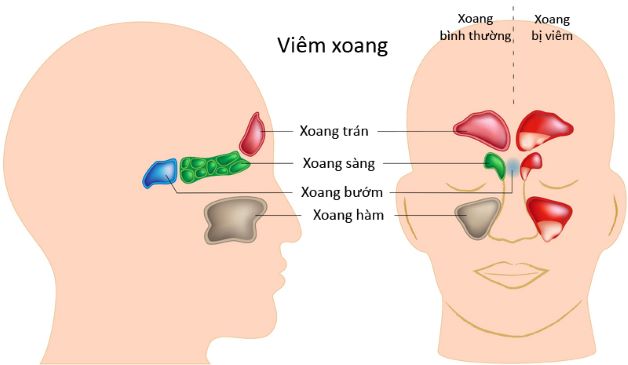 Dựa vào thời gian có thể phân biệt viêm xoang hay viêm mũi dị ứng