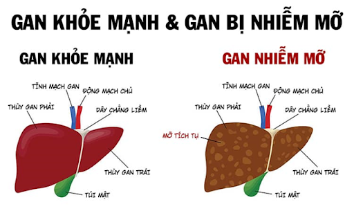 Gan bình thường và gan nhiễm mỡ