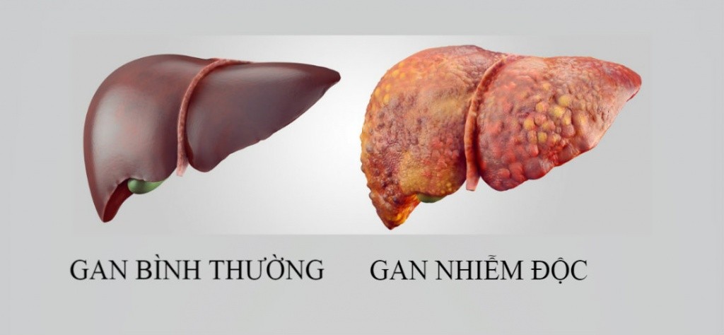 nhận biết gan nhiễm độc