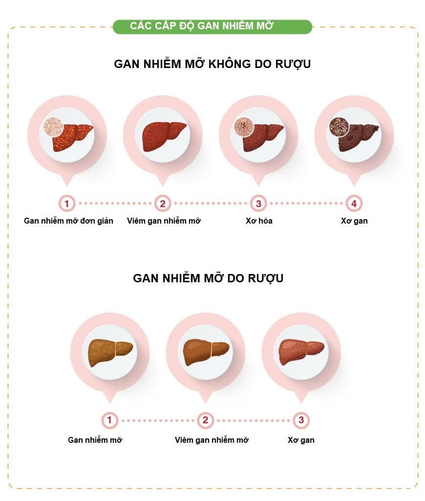 gan nhiễm mỡ có mấy cấp độ