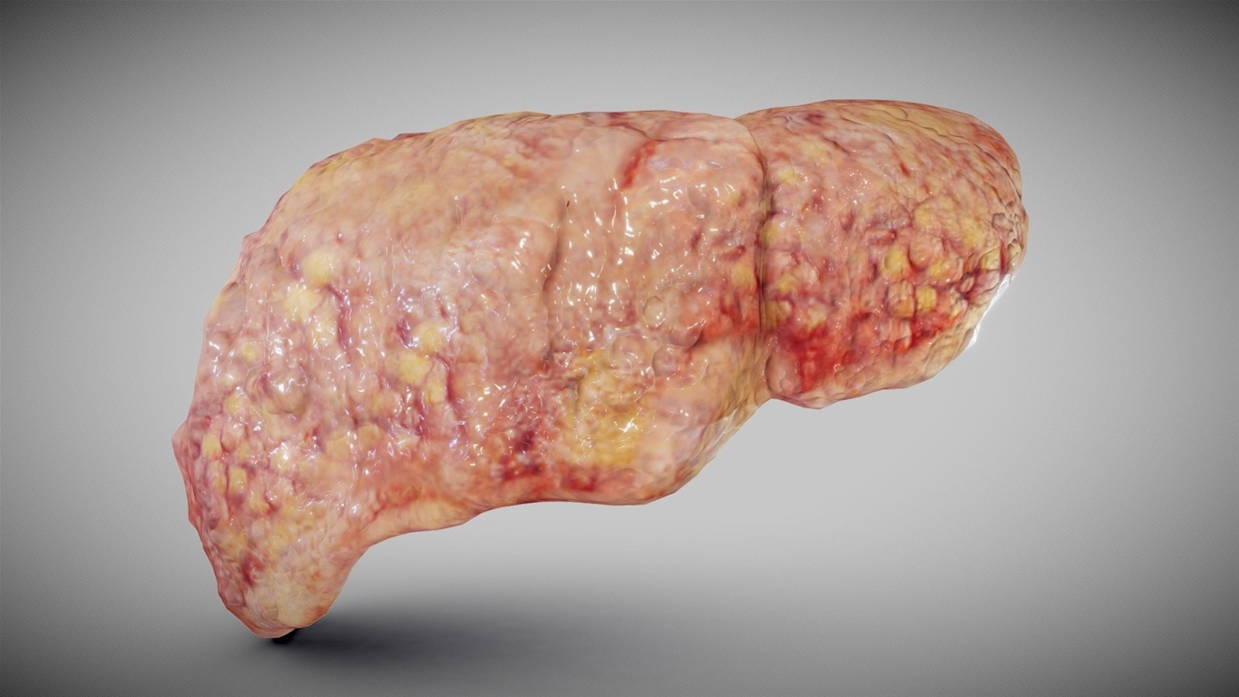 gan nhiễm mỡ kiêng gì