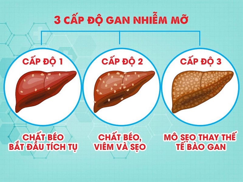 Gan nhiễm mỡ độ 2 có nguy hiểm không?