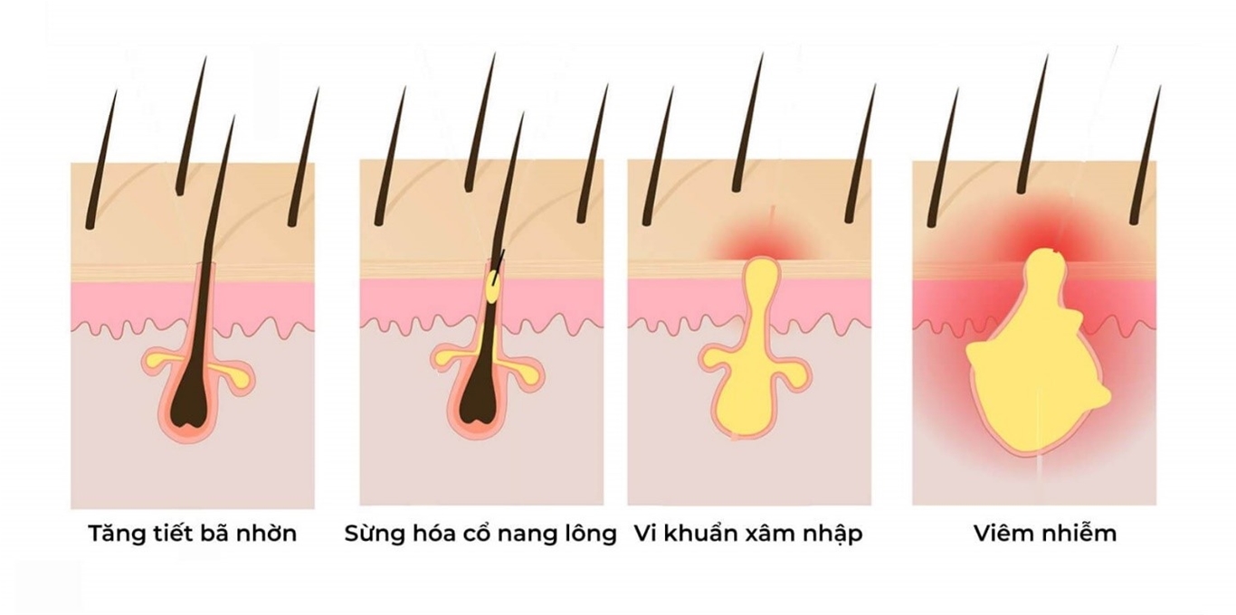giảm mụn tại nhà