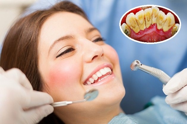 hay chảy máu chân răng là bệnh gì