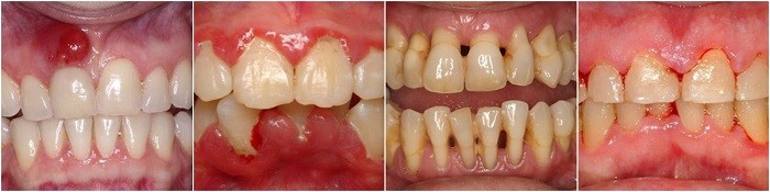 hay chảy máu chân răng là bệnh gì